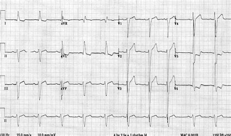 lv ber|Left ventricular hypertrophy .